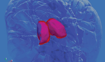 Image: Composite 3D view of the thalamus of healthy controls (outlined in red) and MS patients (magenta). The whole thalamus is generally smaller in MS due to atrophy, and is also shifted (as seen in blue) slightly beyond the position of the normal thalamus due to atrophy of other parts of the brain (Photo courtesy of the University of Buffalo).